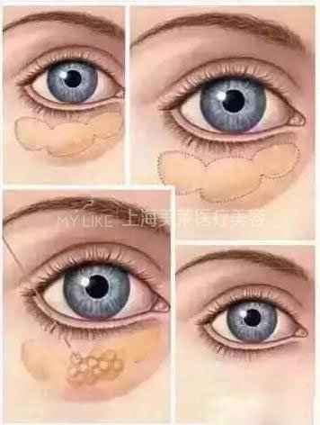 想要永葆青春,显老的眼袋必须割