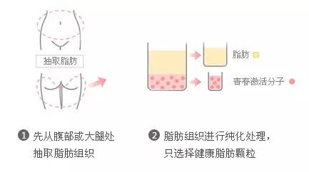 自体脂肪移植填充-脂肪的搬运工