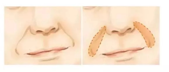 祛除鼻唇沟的方法是什么