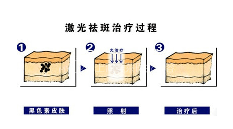 祛斑过程