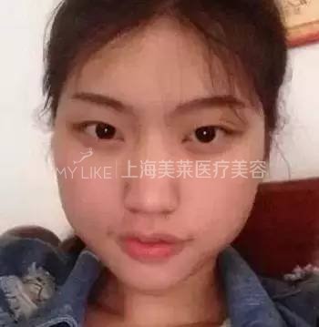 次被建议打瘦脸的时候,其实我是拒绝的