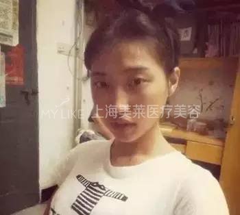 次被建议打瘦脸的时候,其实我是拒绝的