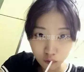 次被建议打瘦脸的时候,其实我是拒绝的