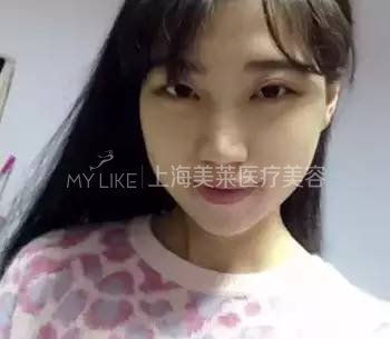 次被建议打瘦脸的时候,其实我是拒绝的