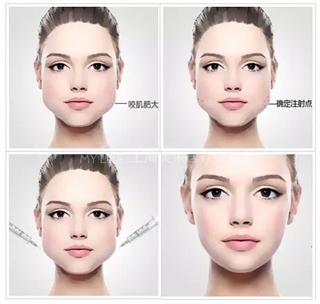 瘦脸问题大全,看完你都知道了!
