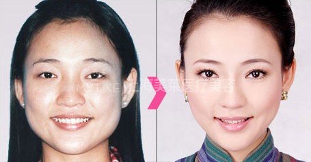 瘦脸问题大全,看完你都知道了!