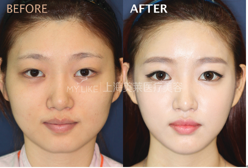 想要容貌焕然一新,20、30、40岁如何微调?